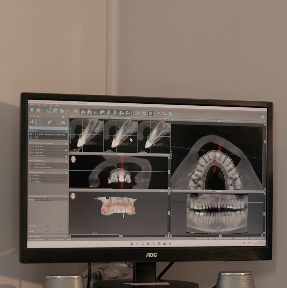 Digital CBCT scan showing root canal anatomy used for treatment planning at Cadbury Dental, Birmingham